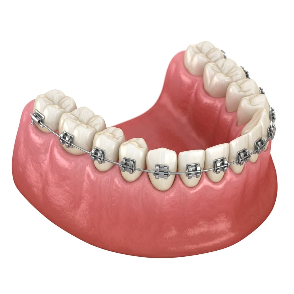 Braces Treatment